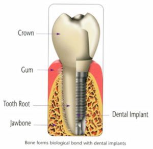 Dental Implants Dallas, Texas | BC Perio